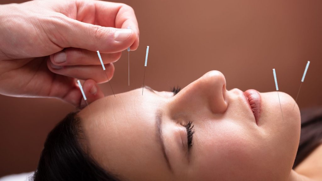 Terapias Alternativas - acupuntura